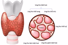 Mỡ máu thấp nguy cơ tái phát tuyến giáp sau phẫu thuật