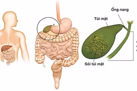 Sỏi túi mật