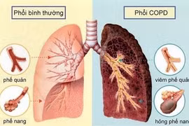 Dấu hiệu khi ngủ cảnh báo bệnh phổi nguy hiểm