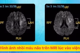 Đột nhiên yếu nửa người, mất ngôn ngữ sau khi thức giấc... do nhồi máu não