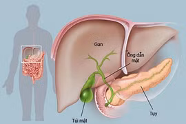 Cách chăm sóc bệnh nhân dẫn lưu đường mật qua da