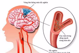 Nắng nóng 41 độ, hãy chú ý đến 7 dấu hiệu sớm của đột quỵ này để giúp bạn thoát chết 