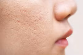 “Điểm mặt” những cách chăm sóc da sai cách khiến lỗ chân lông ngày càng to