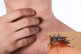 Ký sinh trùng sốt rét gia tăng: Ai có nguy cơ bị bệnh sốt rét?