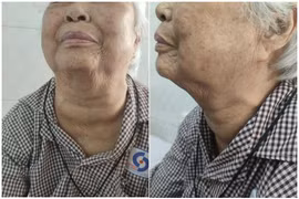 Lấy u bướu khổng lồ chèn ép khí quản cho cụ bà 95 tuổi