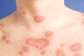 Địa chỉ vàng: Bệnh viện có khả năng chẩn đoán bệnh Lupus ban đỏ