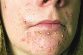 Chăm sóc da mụn đúng cách tránh sẹo xấu