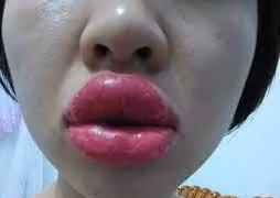 Biến chứng khi xăm môi