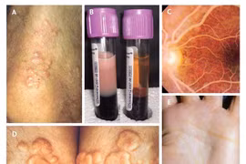Tăng Triglycerid máu nặng chữa như thế nào?