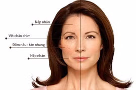 Bác sĩ chỉ cách khắc phục da đồi mồi, nếp nhăn … ở phụ nữ mãn kinh
