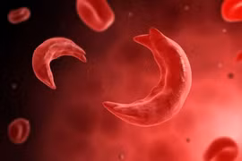 Chỉnh sửa gene điều trị bệnh hồng cầu hình liềm