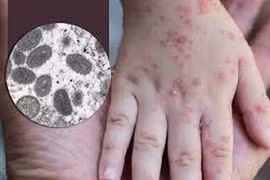 Nhóm người dễ mắc đậu mùa khỉ