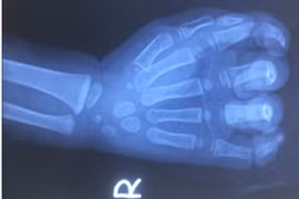Bé trai 23 tháng tuổi nát cả bàn tay do bị cuốn vào dây coroa máy rửa xe