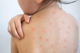 Hà Nội ghi nhận 211 trường hợp mắc sởi trong tuần qua