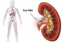 Những thói quen xấu “âm thầm” gây suy thận