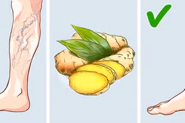 8 cách tự nhiên chữa giãn tĩnh mạch ở chân