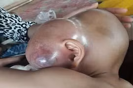 Thương tâm bé 2 tuổi bị u khổng lồ choán hết mặt