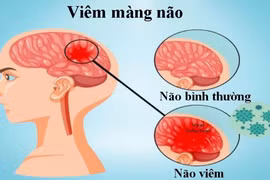 Nhận biết triệu chứng viêm màng não ở trẻ em, chớ dại bỏ qua