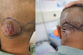 Phẫu thuật Mohs điều trị thành công hai ca ung thư da kích thước lớn 