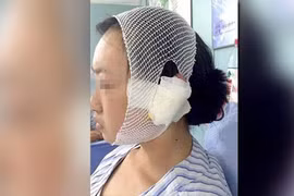 Đánh chó, gái trẻ bị chủ chó cắn đứt tai