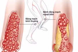 Trời lạnh, cẩn thận chi hoại tử phải cắt cụt do thiếu máu