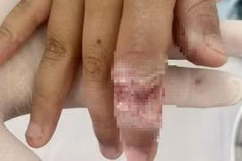 Bé trai bị bỏng tay nặng khi rút điện thoại đang sạc