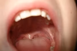 Thấy đốm trên lưỡi tưởng bệnh tình dục, ai ngờ ung thư