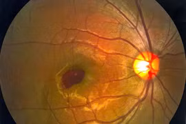 Nam thanh niên suýt bị mù vì đèn laser chiếu thủng mắt