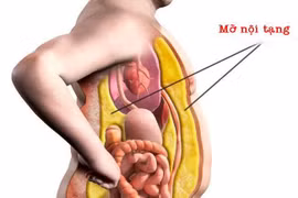 Làm gì để giảm mỡ nội tạng?