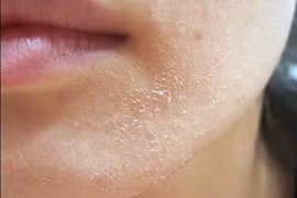 Bí quyết xua tan nỗi ám ảnh khô da trong mùa đông