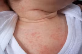 Gợi ý 5 loại thực phẩm tốt cho trẻ bị rôm sảy