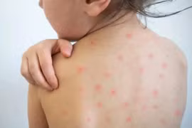 Ai có nguy cơ cao mắc bệnh sởi?