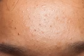 Lỗ chân lông bị tắc nghẽn, nổi mụn, cần làm gì để khắc phục?