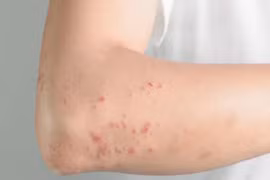 Bị ngứa 10 năm mới biết nhiễm giun đũa chó mèo