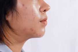 Bỏ túi 5 công thức mặt nạ giúp kiềm dầu, se khít lỗ chân lông