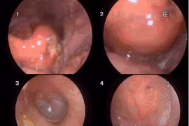 Tự lấy xương cá bị hóc, người đàn ông phù nề hạ họng, thanh quản