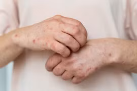 Nhận biết bệnh giang mai qua dấu hiệu ở từng giai đoạn