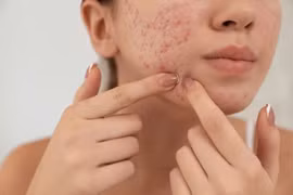 "Tạm biệt" các đốm thâm mụn bằng 5 công thức dưỡng da đơn giản tại nhà