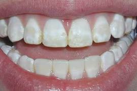 Top thực phẩm có thể "bào mòn" men răng không phải ai cũng biết
