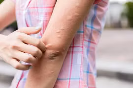 Nguyên nhân bạn bị muỗi đốt nhiều hơn người khác