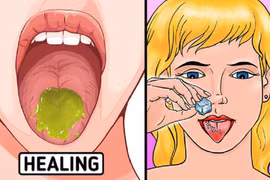 Ăn lẩu, nướng nhiều bị bỏng rát lưỡi và 10 cách chữa lành cấp tốc