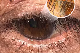 Hàng trăm con rận mu làm tổ trên mi mắt người đàn ông