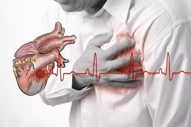 Bác sĩ chỉ rõ triệu chứng điển hình nhồi máu cơ tim cấp