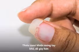 Video: Dấu hiệu cảnh báo cơ thể thiếu canxi chớ coi thường