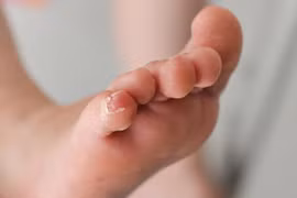 Dấu hiệu bệnh giang mai bẩm sinh ở trẻ