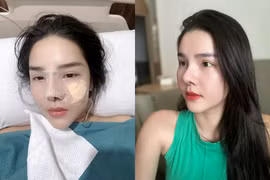 Sửa mũi lần 4, nhan sắc vợ của Mạc Hồng Quân gây chú ý