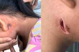 Bệnh nhi 15 tuổi tử vong vì nhiễm Whitmore, Bộ Y tế ra khuyến cáo