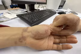 Giun bò lổm ngổm dưới da người phụ nữ nuôi 3 con chó, 5 con mèo
