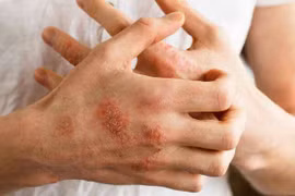 Dấu hiệu bất thường trên da cảnh báo bệnh tiểu đường
