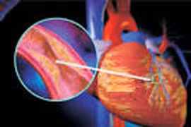 Xơ vữa mạch vành 70% có nên đặt stent?